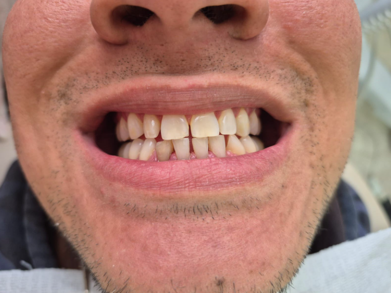 Depois - Limpeza Profissional