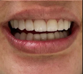 Depois - Lentes de Resina