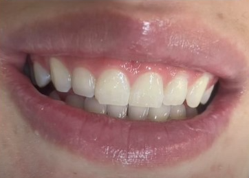 Depois - Clareamento Dental