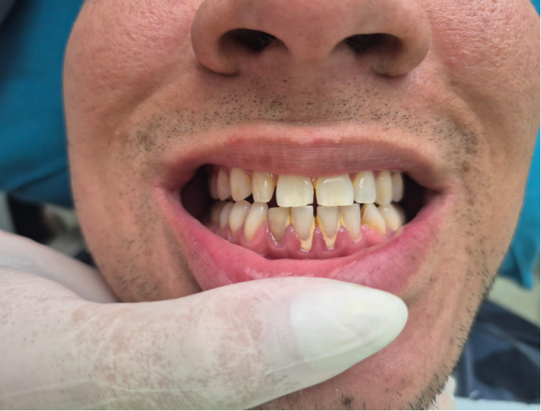 Antes - Limpeza Profissional