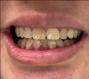 Antes - Lentes de Resina