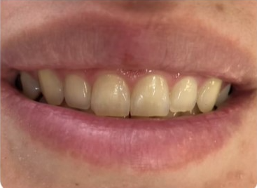 Antes - Clareamento Dental